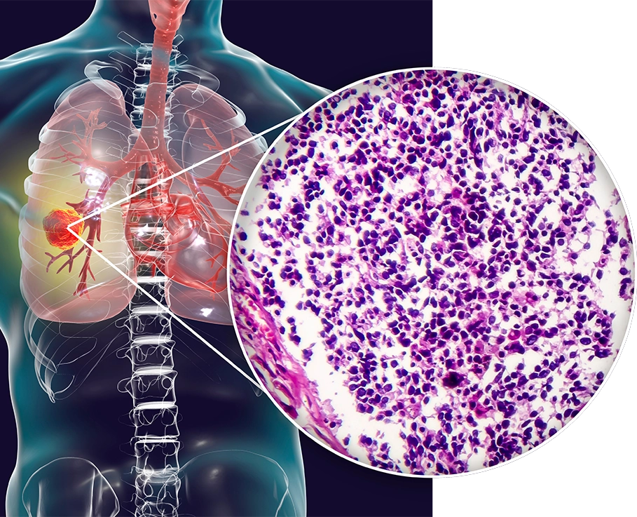 lung_cancer_diagram